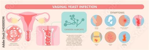 Douche Vagina Odor Clean Blood Flora Ectopic Yeast Bacterial Pelvic Genitals Swelling Pain Sex