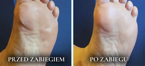 Pedicure Leczniczy W Naszym Gabinecie Profesjonalna Piel Gnacja Na