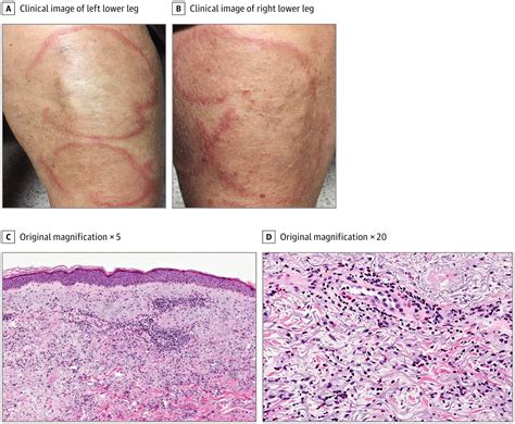 Annular Plaques In A Woman Receiving Systemic Immunotherapy Allergy And Clinical Immunology