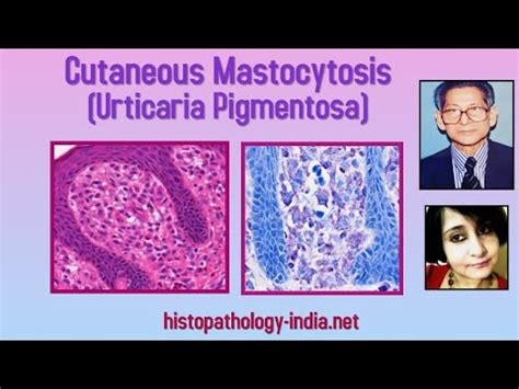 Pathology Of Urticaria Pigmentosa Cutaneous Mastocytosis By Dr