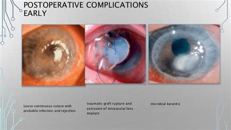 Corneal And Refractive Surgery