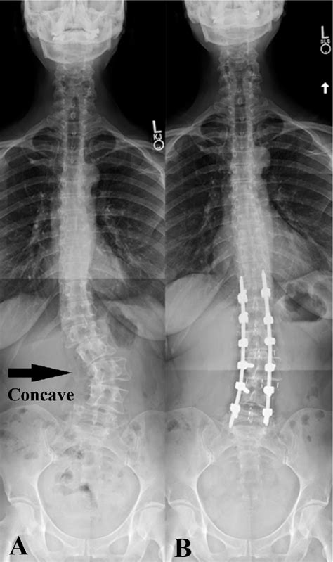 Concave Vs Convex Scoliosis