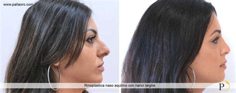 Rinoplastica Foto Pallaoro Medical Laser