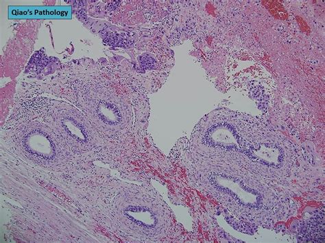 Qiaos Pathology Testicular Choriocarcinoma A Photo On Flickriver