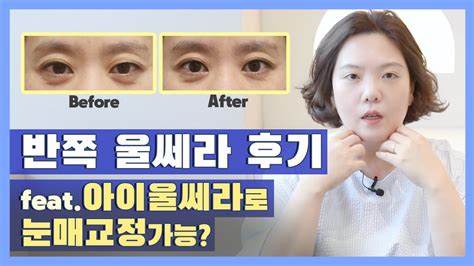 Eng 반반 울쎄라 결과아이울쎄라 꿀팁 리프팅 레이저로 눈매교정 눈밑지 가능 Tips For Eye