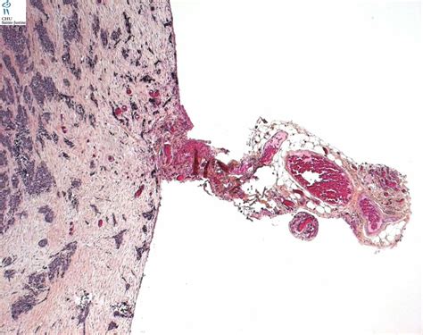 Desmoplastic Small Round Cell Tumor Humpath Human Pathology