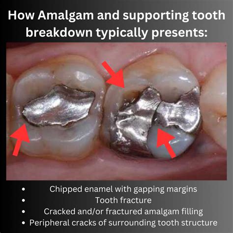 The Art Of Safe Amalgam Removal Mercury Detox Apex Dental