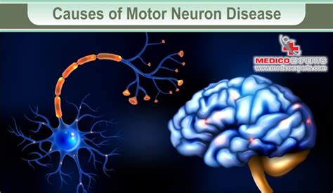 Motor Neuron Disease Treatment In India Current Options