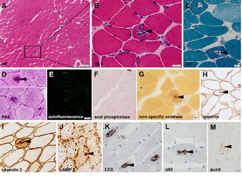 Histology of cross-sectioned muscle fibers of patient B1. Hematoxylin ...