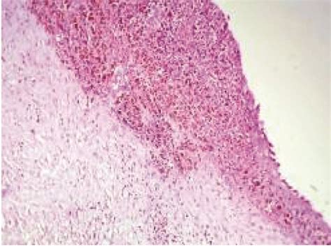 Peritoneal Macrophage Containing Hemosiderin