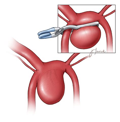 Anterior Communicating Artery Aneurysm | The Neurosurgical Atlas