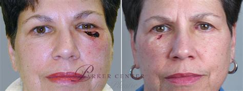 Skin Cancer Treatment Before And After Pictures Case 1053 Paramus New Jersey Parker Center