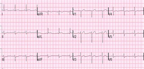 Dr. Smith's ECG Blog: Is the LAD really completely occluded when there ...