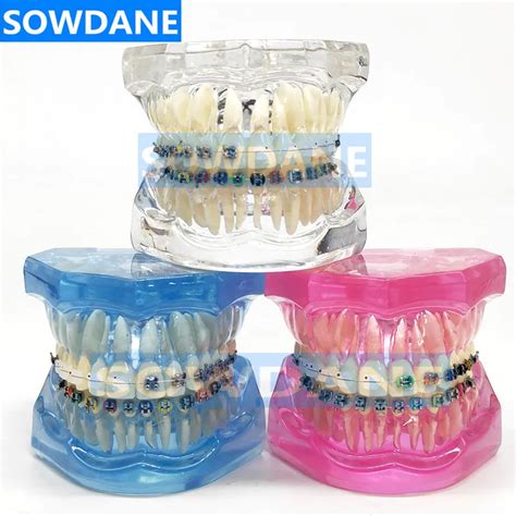 Tandheelkundige Orthodontische Tanden Model Met Keramische En Metalen