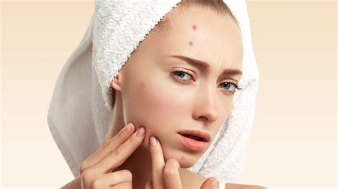 How To Remove Pimples 5 Ways To Get Rid Of Pimples Fast