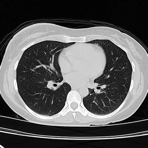 Incidental Breast Lesion Detected On Ct Image Radiopaedia Org