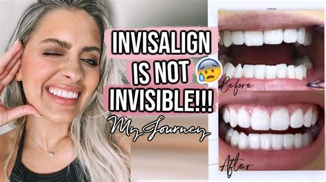 Shaving My Teeth Down For Veneers Lol Jk My Invisalign Journey Youtube