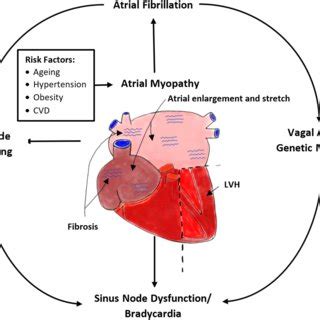 Pathophysiological mechanisms linking AF and SND. This figure... | Download Scientific Diagram