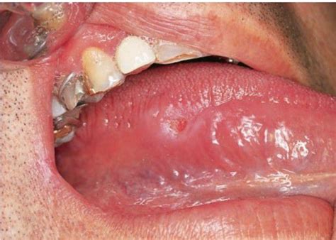 Chronic Traumatic Ulcer MEDizzy