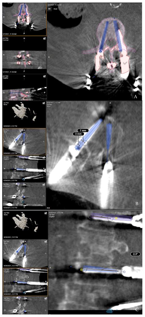 Jcm Free Full Text Initial Intraoperative Experience With Robotic