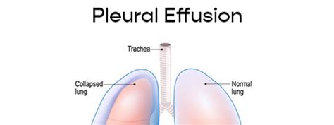 Pleural Effusion Causes Symptoms And Treatment Netmeds