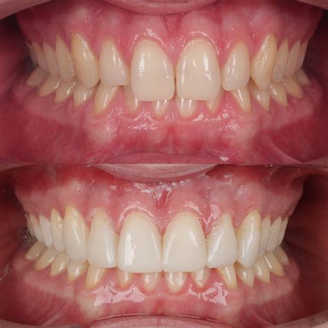 Composite Bonding — Galway Dental Group 