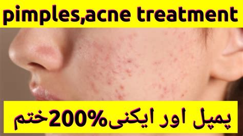 How To Get Rid Of Ance Pimple Pimples Remove Home Remedy Ance