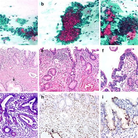 Gastric Type Adenocarcinoma In Situ Of Uterine Cervix Cytological And