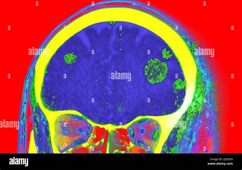 Coloured Computed Tomography Ct Scan Showing Secondary Malignant Cancerous Tumours Green