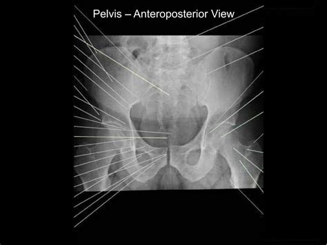 Pelvis Anteroposterior View Diagram Quizlet