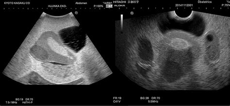 Female Pelvic Ultrasound Phantom KYOTO KAGAKU