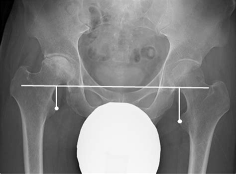 Preoperative Anteroposterior Pelvis Radiograph Measurement Measured