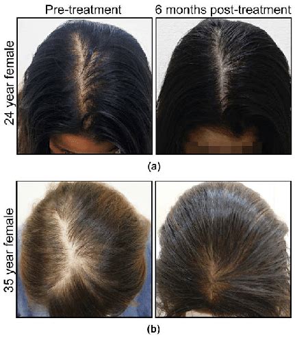 Representative Photographs Of Hair Re Growth Before And After