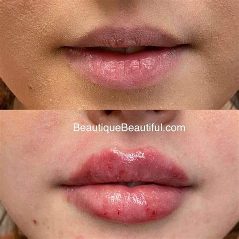 Best Lips In Knoxville Tn Beautique Medical Anti Aging