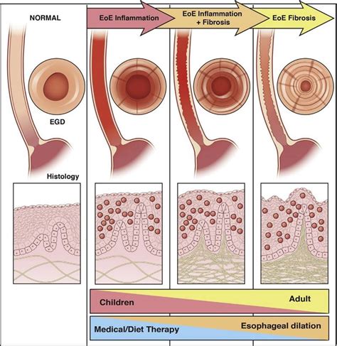 Esofagite Eosinof Lica Uma Atualiza O Epidemiologia Fisiopatologia