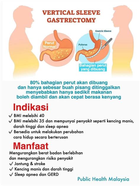 Pembedahan ‘ikat Perut Antara Cara Kurangkan Berat Badan Tapi Tak