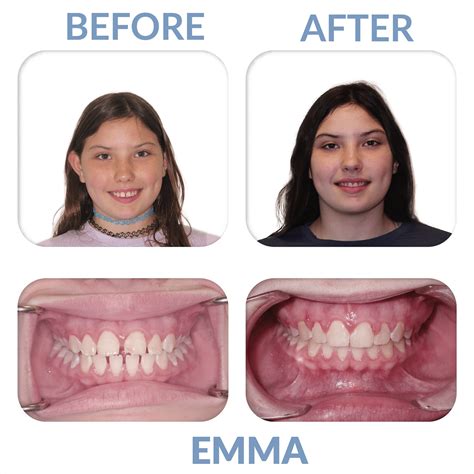 Before And Afters Miler Orthodontics Orthodontist Sc 29910