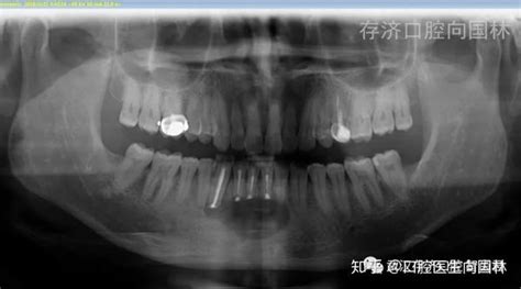 典型案例｜超声骨刀下颌骨囊肿摘除根尖切除根管倒充填术 知乎