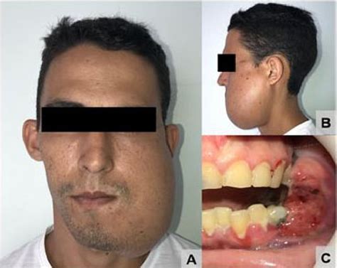 Initial Aspect Of The Patient Presenting A Extraoral Frontal Aspect