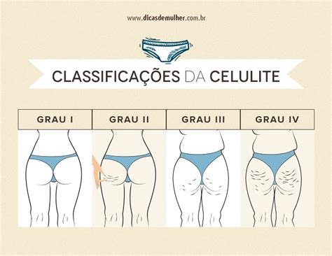 Qu Es La Celulitis Tipos Causas Y Tratamientos Naturales