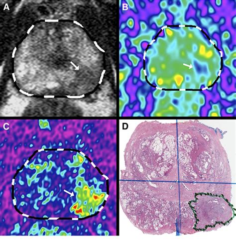 Pdf Clinical Application Of A 3d Ultrasound Guided Prostate Biopsy