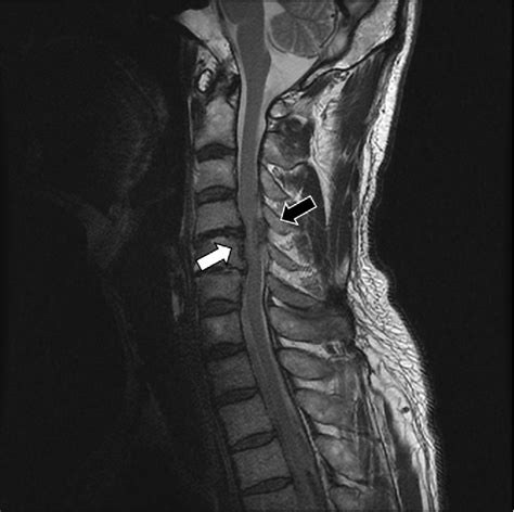 Figure From Cervical Epidural Hematoma With Brown Sequard Syndrome