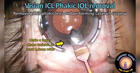 Cataract Removal With Intraocular Lens Implant Eye Surgery Guide