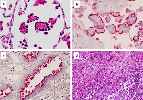 Micropapillary Pattern And Grade Of Stromal Invasion In PT1