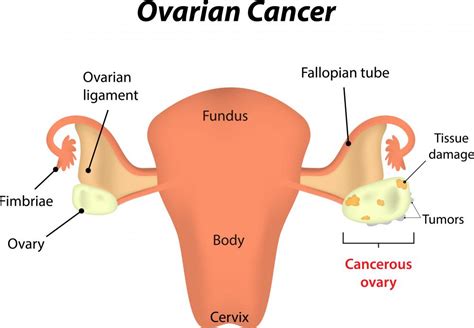 What Are The Different Types Of Epithelial Cancer