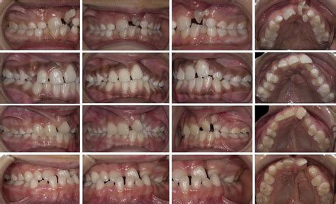 Orthodontic Treatments In Cleft Lip And Palate Patients Oral Health Group