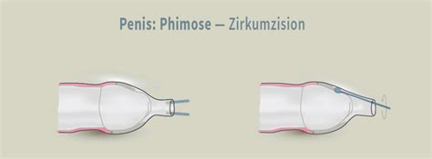 Phimose Vorhautverengung Symptome Risiken OP MOOCI