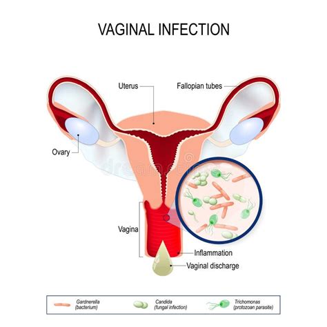 Inflammation Du Vagin Vaginitis Infographie Illustration De Vecteur Sur