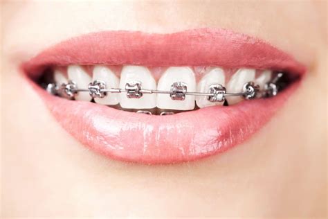 Whats The Difference Between Traditional Self Ligating Braces