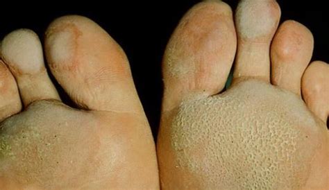 Jamur Di Kaki Id